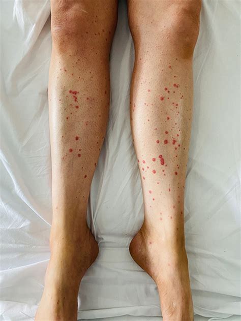 View 7 Allergic Reaction Skin Rash During Tb Treatment - khowarnewall