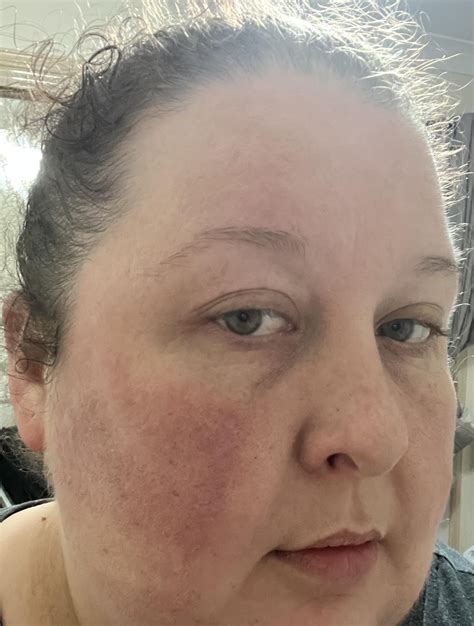 Whenever I am sick, one side of my face gets much more red than the