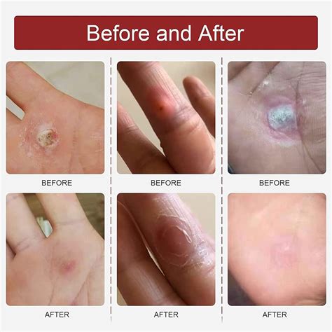 Viowey 24Pads Corn Remover Pads Wart Remover Foot Corn Remover Patch