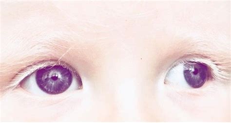 Pin on ALBINO EYES [глаза альбиноса]