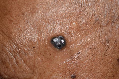 What Does Skin Cancer Look Like?