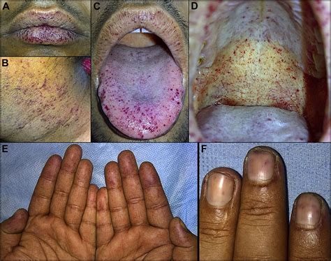 Hereditary Hemorrhagic Telangiectasia Brain