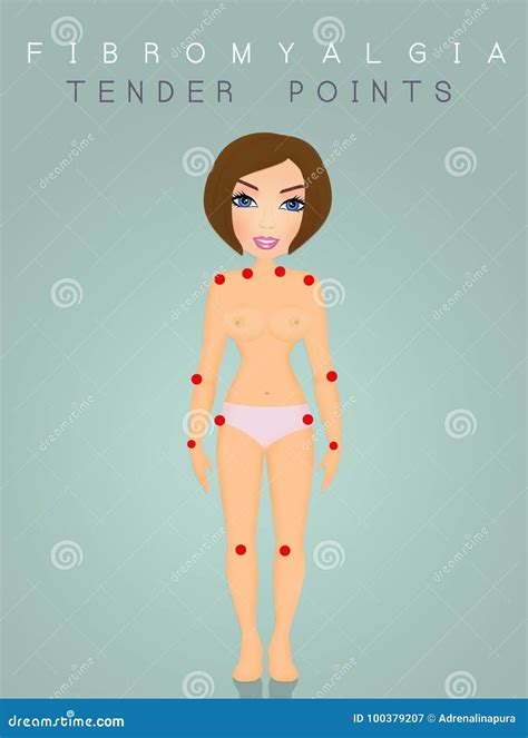 Fibromyalgia Tender Points Chart 4