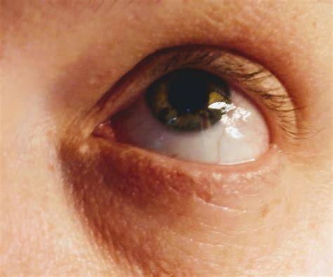 What Is This White Spot On My Face at Leslie Hackett blog