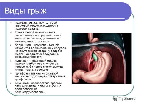 Презентация на тему: "Грыжи". Скачать бесплатно и без регистрации.