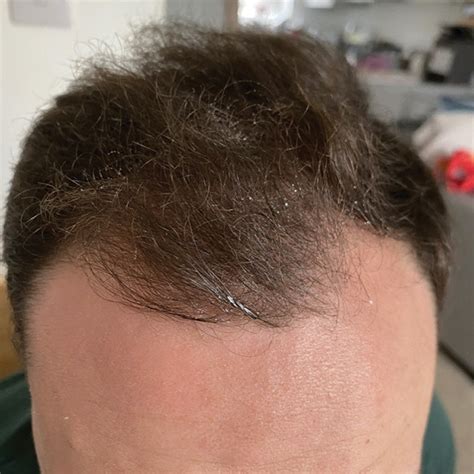 Buy Topical Finasteride & Minoxidil for Hairloss | Sons UK