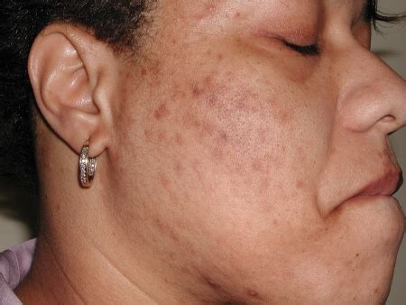 Post Inflammatory Hyperpigmentation | APAX Medical & Aesthetics Clinic