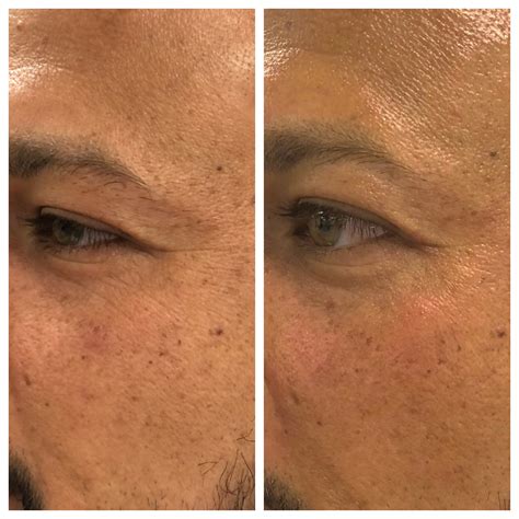 PRX Derm Perfexion | Acqua Blu Medical Spa