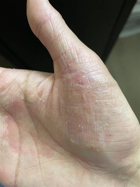 dyshidrotic eczema : r/Dyshidrosis