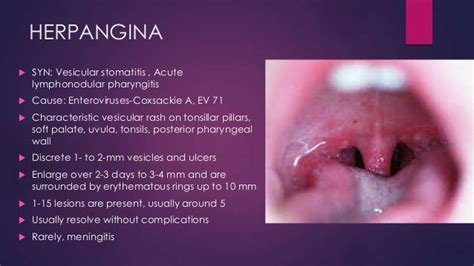 Lesions of oral cavity