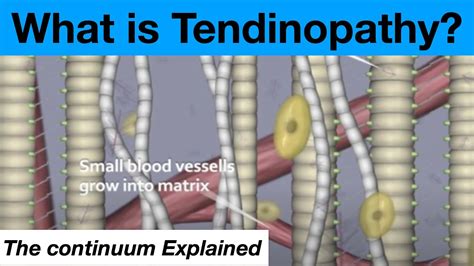The Tendinopathy Tendon Tendonitis Continuum Theory Explained - YouTube