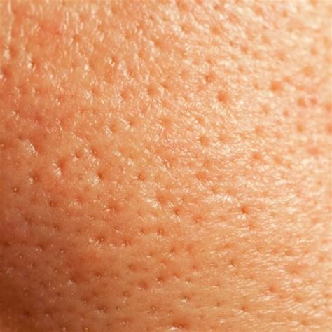 pores