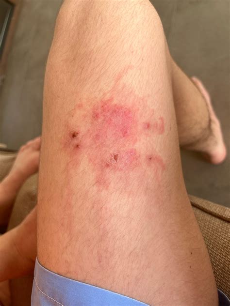 Mysterious Rash - Does anyone know what it is? Impetigo? : r/Dermatology