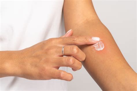 Insect Bites That Cause Muscle Pain: Culprits [4 Treatments] – Glamour