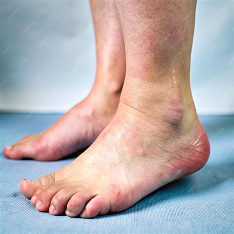 educational images  swollen ankles  women understanding common