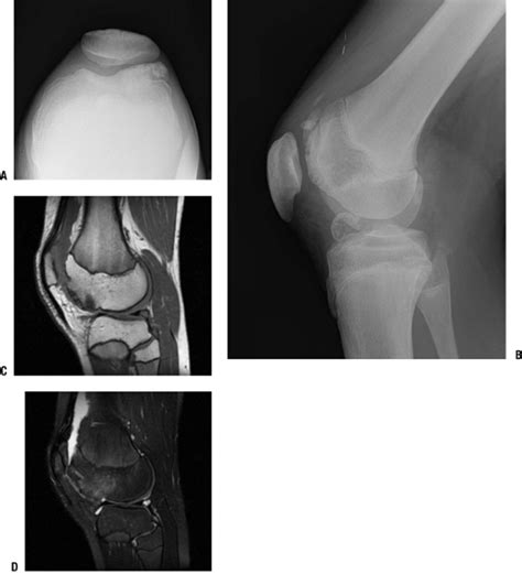 Diarthrodial Joints - TeachMe Orthopedics