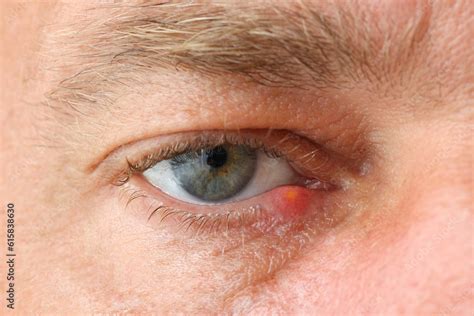 fotografia  stock close  mans eye  stye symptoms stye