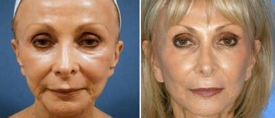 Fat Injections Before & After Photos | CosmetiCare