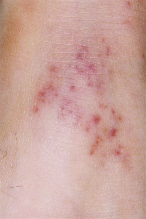 Non-Blanching Rash: Meaning, With Fever, Treatment