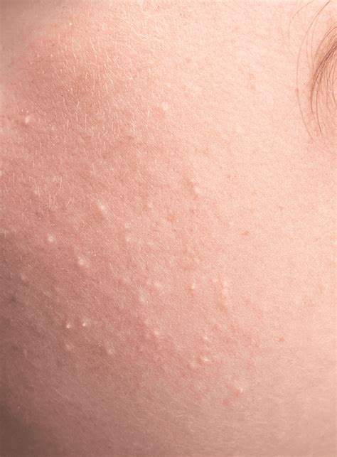 Milia Seed Removal | Thomson Medical