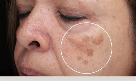 dermatology center  loudoun blog brown spots age spots