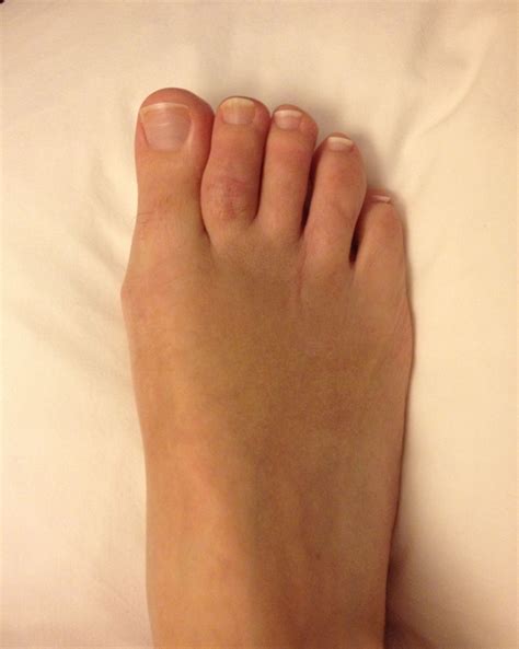 Four months post-op. Claw toe and Morton's Neuroma. | Claw toe, Morton