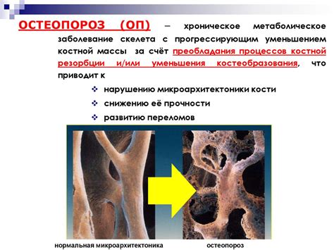 Остеоартроз, остеопороз, саркопения – три кита геронтологии - online ...