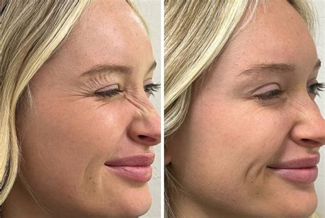 Bunny Lines: Botox Treatment for Nose Wrinkles