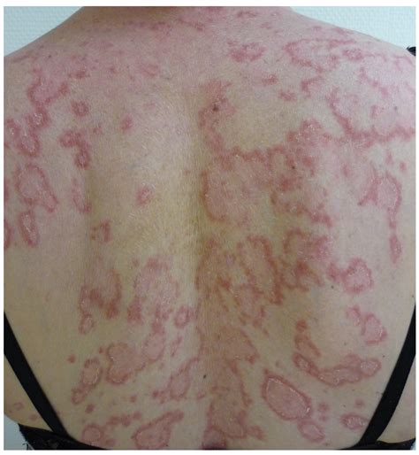 Erythema Annulare Centrifugum Histology