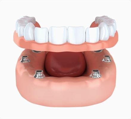 Snap-On Dentures - Dr. Steven Curry, DDS