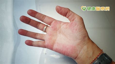 蝴蝶病「紅斑性狼瘡」典型症狀曝 致死率高常人近三倍！ - 健康醫療網