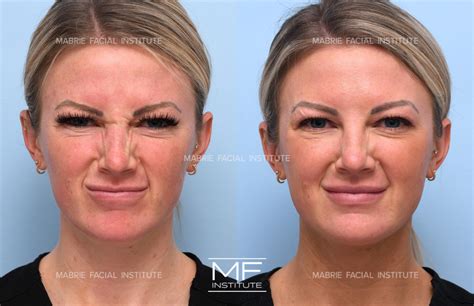 Bunny Lines & Nose Wrinkles Before and After Pictures Case 818 | San