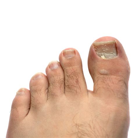 Toenail Falling Off: The #1 Best SECRET Podiatrist Tips