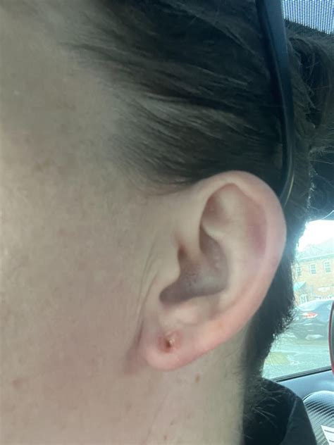 Allergic reaction or something else?? : r/Stretched