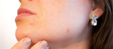 Reducing Acne Scars with Glycolic Acid - Coast Southwest