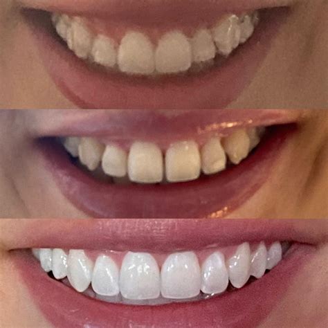 Breathtaking Invisalign Transformations: Jaw-Dropping Before and After Photos to Inspire Your Smile 1