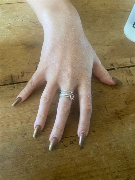 Flaky hand : r/DermatologyQuestions