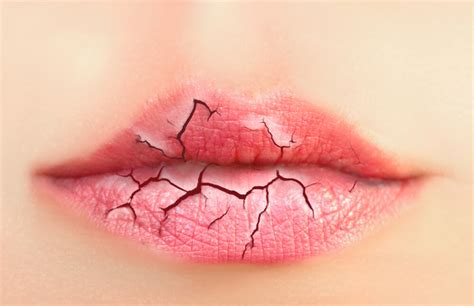 Chapped Lips: Causes and Home Remedies