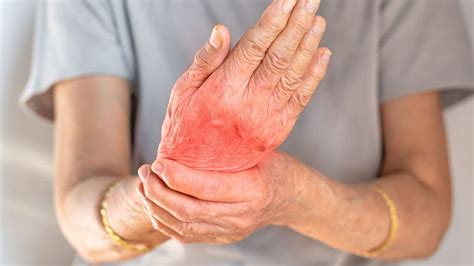 artrita reumatoida cauze simptome  modalitati de traire cu ea