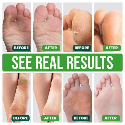 VeraCare Lavender Foot Peel Mask - 2 Pairs - Exfoliating & Moisturizing