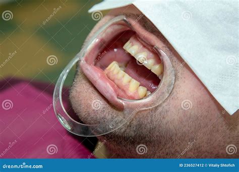 open mouth  dental treatment stock photo image  glove hygiene