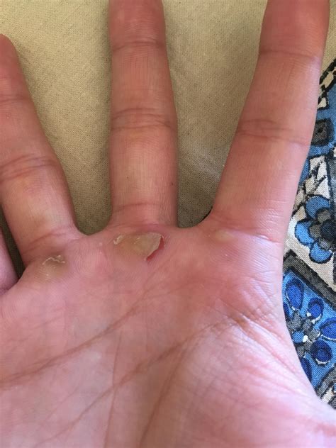 Hey guys, I had a callus tear on me for the first time. Looking for