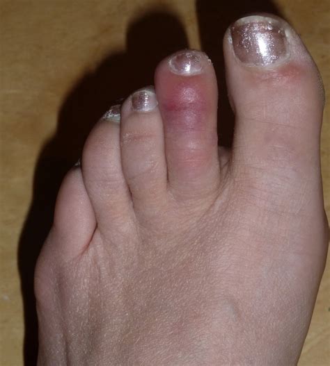 QWERTY Mum: Chilblains