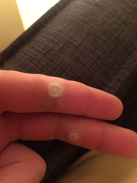 Duct tape for 1 month did nothing. Day 1 ACV. : r/Warts