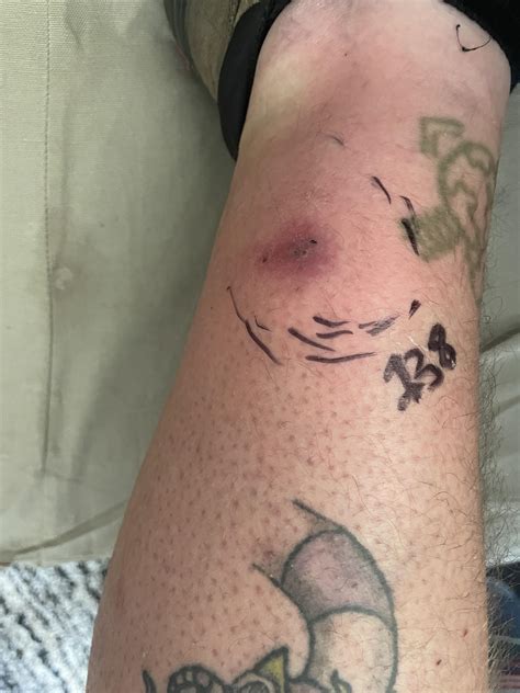 Rattlesnake Bite What Do You Do at David Delarosa blog