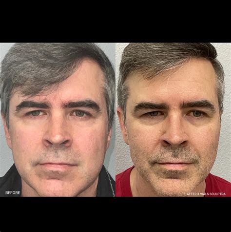 Sculptra vs Radiesse - A Thorough Comparison - Med Supply Solutions