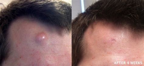 cyst removal results  skin surgery laser clinic london bristol