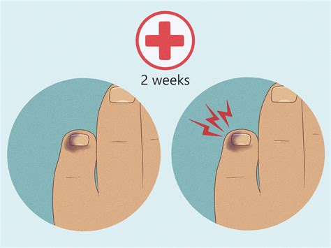 How to Heal a Bruised Toe: 11 Steps (with Pictures) - wikiHow
