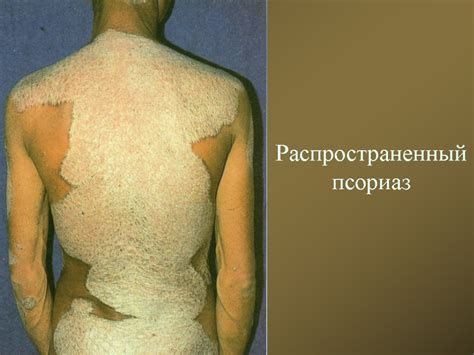 Псориаз и красный плоский лишай Составитель: к. м.