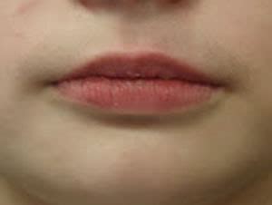 Lip Changes - Cherry Creek Orofacial MyologyCherry Creek Orofacial Myology